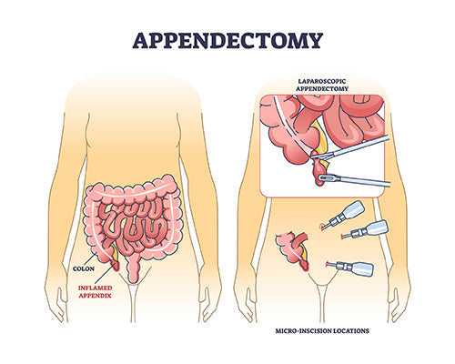 Appendicitis – Causes, Symptoms, Surgery