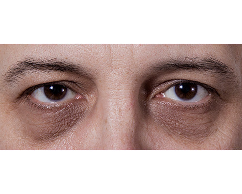 FAQ: Dark Circles Under The Eyes