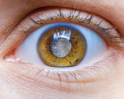What Are Cataracts?